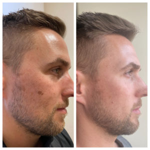 Face Treatment Before & After Image | Sego Lily Spa | Bountiful, Layton, and Midvale, UT