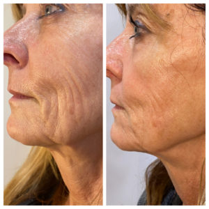 Face Treatment Before & After Image | Sego Lily Spa | Bountiful, Layton, and Midvale, UT