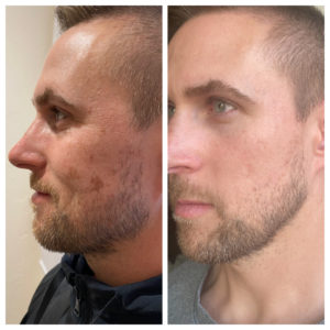 Face Treatment Before & After Image | Sego Lily Spa | Bountiful, Layton, and Midvale, UT