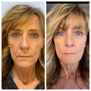 Face Treatment Before & After Image | Sego Lily Spa | Bountiful, Layton, and Midvale, UT