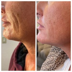 Face Treatment Before & After Image | Sego Lily Spa | Bountiful, Layton, and Midvale, UT