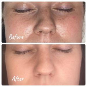 Face Treatment Before & After Image | Sego Lily Spa | Bountiful, Layton, and Midvale, UT