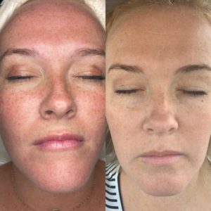 Face Treatment Before & After Image | Sego Lily Spa | Bountiful, Layton, and Midvale, UT