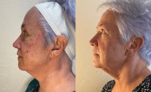 Face Treatment Before & After Image | Sego Lily Spa | Bountiful, Layton, and Midvale, UT