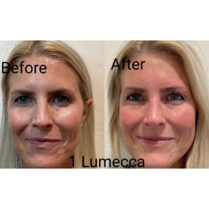 Before and After results of Lumecca treatment at Sego Lily Spa in Bountiful, Layton, & Midvale, UT