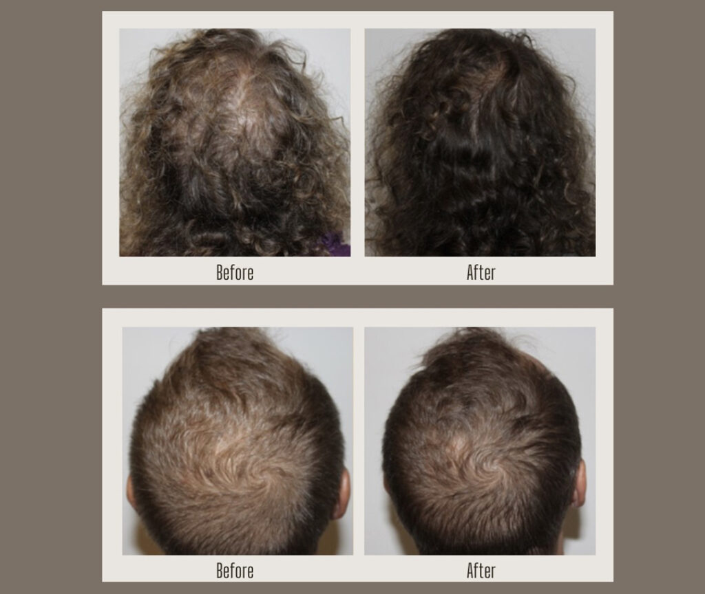 HydraFacial Keravive treatment before and after results at Sego Lily Spa in Bountiful, Layton, & Midvale, UT